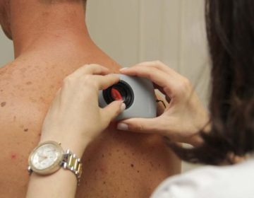 Apesar de não ser tão comum, melanoma é o câncer de pele com a maior taxa de mortalidade