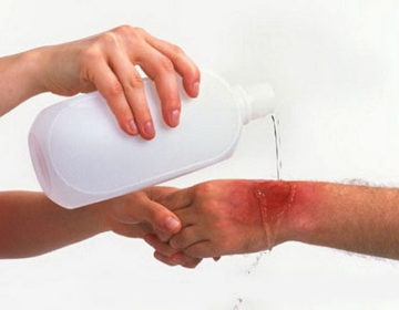 Mais de um milhão de pessoas sofrem queimaduras no Brasil por ano