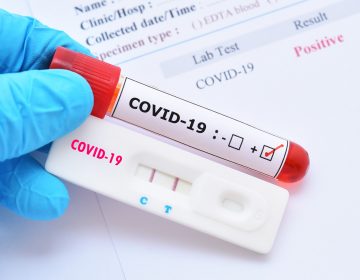 Novo boletim registra 81 novos casos por Coronavírus em 24h